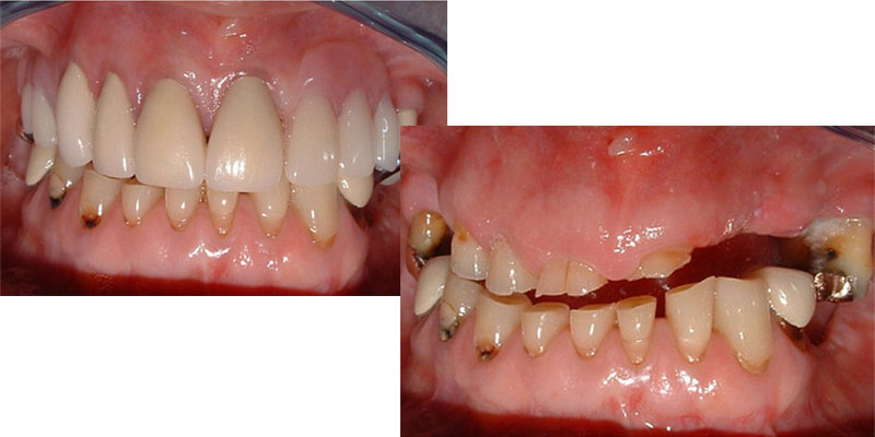 چگونه ازعوارض سایش دندان‌ها پیشگیری کنیم؟