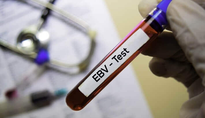 آزمایش ebv چیست ؟ علت تجویز+ تفسیر منفی و مثبت بودن آزمایش