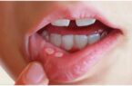 راه‌های جلوگیری از «آفت دهان کودک»