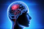 «کرانیوفارنژیوما» یکی از نادرترین تومورهای مغزی !