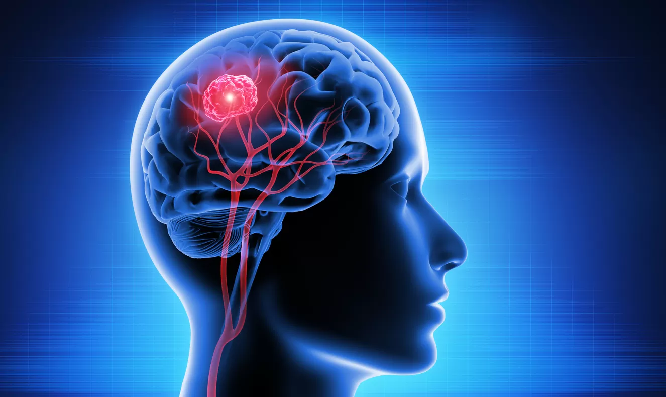 «کرانیوفارنژیوما» یکی از نادرترین تومورهای مغزی !